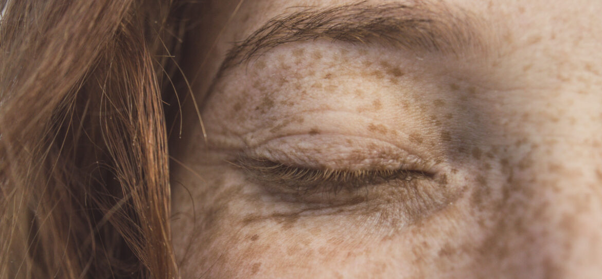 premataure aging of the skin