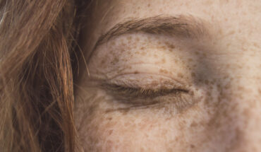 premataure aging of the skin